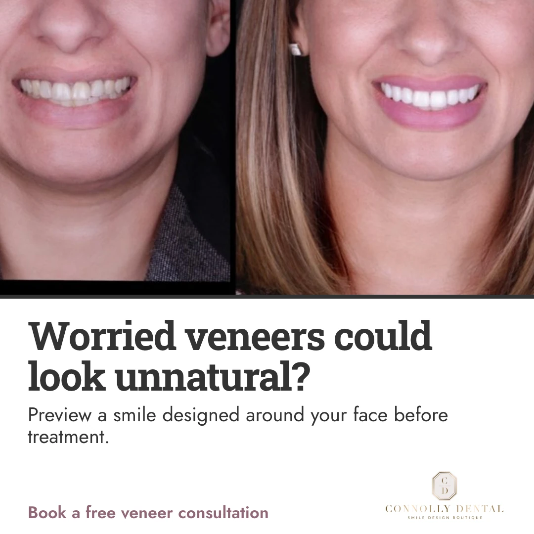 Porcelain veneers that suit the person ad creative